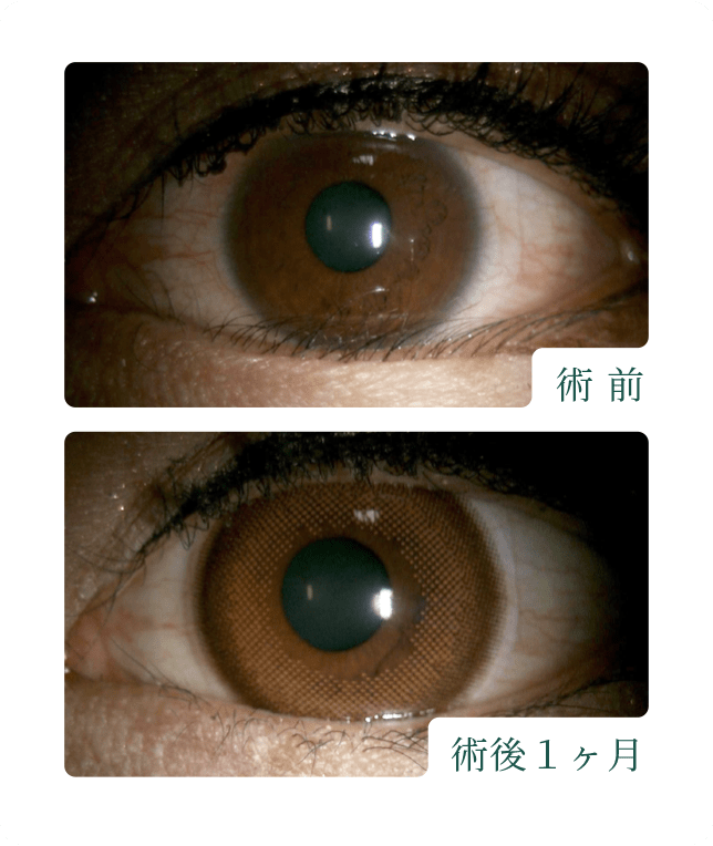 皮膚切開・瞼縁眼輪筋切除法