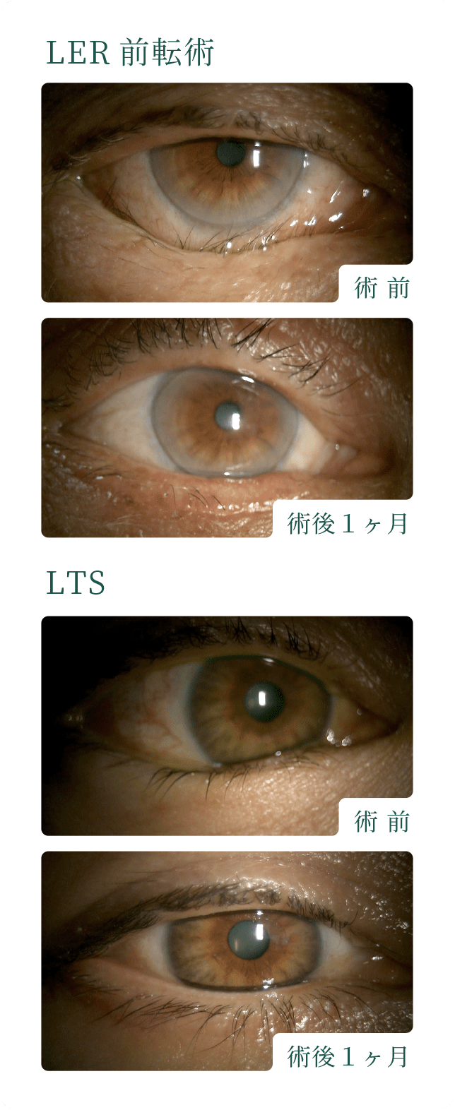 LER前転術・LTS